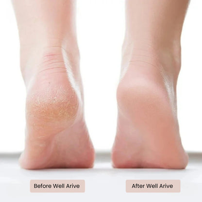Well Arive™ Electric Callus Remover