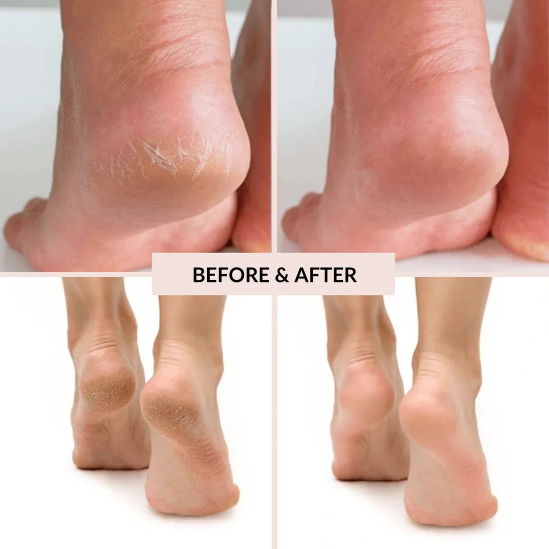 Well Arive™ Electric Callus Remover